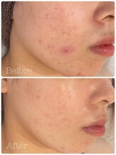 トゥモロー(TOMORROW)/ハーブピーリング/肌質改善