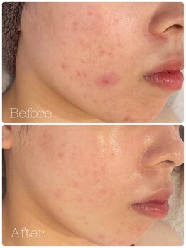 トゥモロー(TOMORROW)/ハーブピーリング/肌質改善