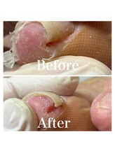 プラスキュア 用賀店(+CURE)/巻き爪矯正【1爪】＋爪切￥8800