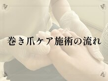 ルポ(REPOS)/巻き爪ケア施術の流れ