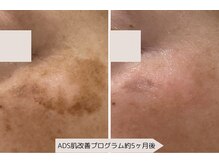 ユーブルーム(youbloom)/ADSで肌改善☆ さらに3ヶ月経過