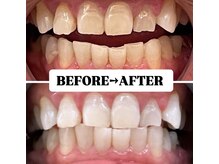 ホワイトニングサロン 豊中/Before&After美白ホワイトニング