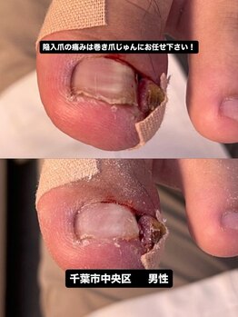 巻き爪じゅん 千葉駅前店/今つらい巻き爪の痛みを改善