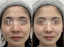 ルテア(Retea.)/REVIハーブピーリング