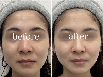 ルテア(Retea.)/REVIハーブピーリング