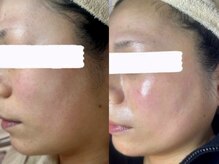 ナナラ/究極小顔！美顔筋トレ×脂肪分解