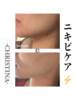 アイリス(AIRIS)/毛穴洗浄/ニキビケア/シミケア