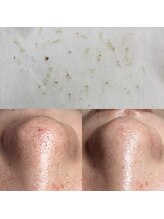 ビューティーネイル(Beauty Nail)/毛穴エクストラクション