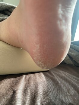 グリーングリーン(GREEN GREEN)/ガサガサカチカチひび割れbefore