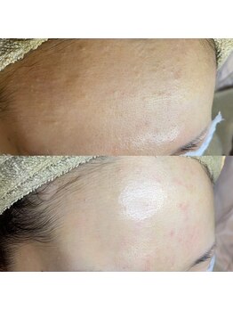 アデュラリアン(Adularian)/毛穴エクストラクション