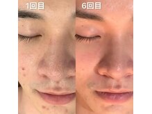 エステサロン ジュブリー/男性限定ダイヤモンドピーリング