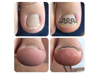 事例【ツメフラ法巻き爪矯正】