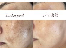 ホワイトアクア 明石店(WHITE AQUA)/ララピール/兵庫/明石/毛穴/小顔