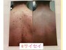 7月限定10%オフ¥6500→¥5850ハイドラシャイン背中ニキビケアコース当日予約×