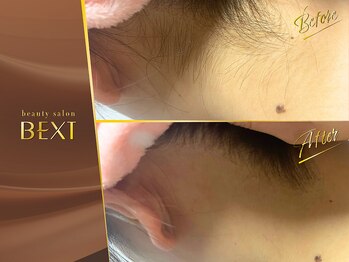 ベクスト(BEXT)/うなじ脱毛(PRO)