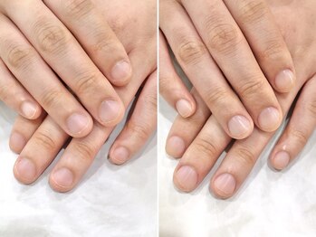 リファーレ(RIFARE)/【深爪矯正】初回から変わる!