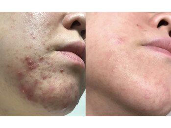 エミナル(eminal)/ビフォーアフター/ニキビ/梅田