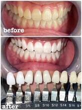 エクシアホワイトニング 新小岩店/ホワイトニングビフォーアフター