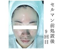 ヴィヴ 熊本(ViV)/【セルマンピーリング】after