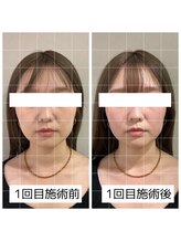 ヴィーライン 大阪梅田院(VeLine)/鍼灸／美容鍼／小顔／大阪／梅田