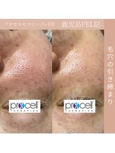 フェリス(FELIZ)/お肌プロセル×1回