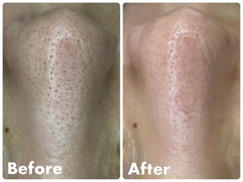 トゥルリア(TRULIA)/いちご鼻撃退コース！1回目！