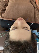 ハリファ鍼灸院 横浜関内院(HariFa鍼灸院)/美容鍼施術/美容鍼