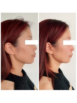 ビーアンドアイ シズオカテン レディース(B&I SHIZUOKA)/芸能人も絶賛!小顔骨格矯正