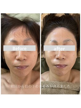 ミピマムマール(Mipimam Maaru)/お客様before→after