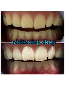 ホワイトニングショップ 越谷店/