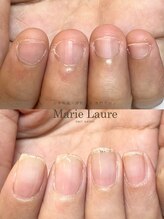 マリーロール 梅田店(Marie Laure)/自爪育成/深爪矯正/ネイルケア