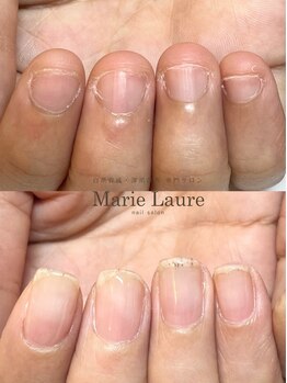 マリーロール 梅田店(Marie Laure)/自爪育成/深爪矯正/ネイルケア