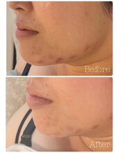 トゥモロー(TOMORROW)/ハーブピーリング/肌質改善