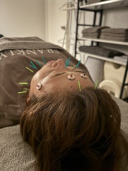 ラフテル鍼灸整骨院/美容鍼とお灸で眼精疲労解消♪