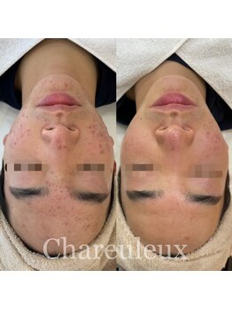 シャルル ストア 京都三条通(Chaleureux Store)/お肌悩み・ボコっとしたニキビ