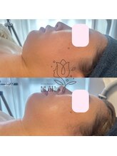 ポムハヌル(pom.haneul)/マイクロ波リフト大阪