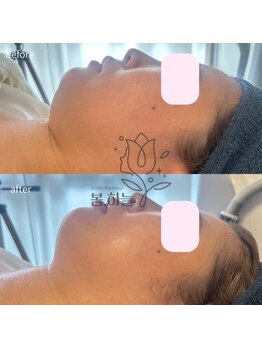 ポムハヌル(pom.haneul)/マイクロ波リフト大阪