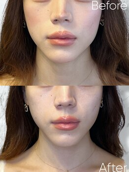 ルミライ(Lumirai)/20代はたるませない肌貯金に!