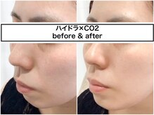 ディアメ(Diame)/話題のハイドラ×CO2で別人肌☆