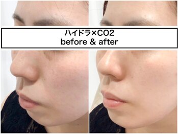 ディアメ(Diame)/話題のハイドラ×CO2で別人肌☆