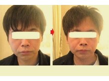 サロンドエステケイワイ(de KY)/フェイシャル☆小顔・タルミ改善