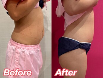 ソイズ 新保店(SOIS)/■脂肪冷却&電磁パルス 変化写真