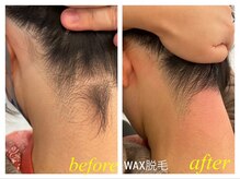 フォトウエディング前や細かい産毛が気になる方Wax脱毛オススメ