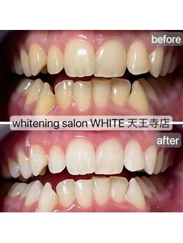 ホワイト 天王寺店(White)/Whitening症例before→after