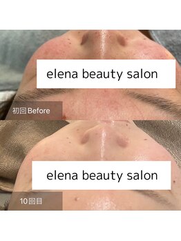 エレナ(Elena)/陶肌トリートメント