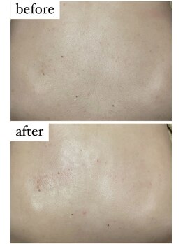 ユニセックスサロン アンシェル(UNISEXSALON UNCHEL)/背中ピーリング&背中脱毛