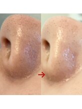 ハズキ(HAZUKI)/ハーブピーリングで悩み改善