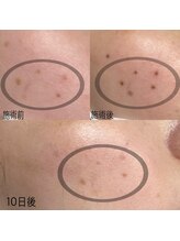 ブライズ(BRISE)/ポロポロはがれるシミケア