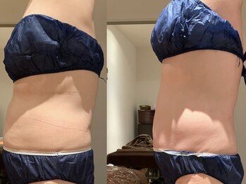 ビーグレイス(Vigrace)/ハイパーナイフEX/シェイプ