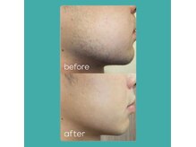 フューチャー(Future)の雰囲気（↑ヒゲ脱毛ビフォーアフター女性だけではなく、男性利用可能◎）